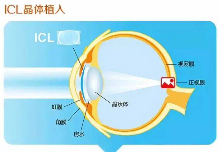 在青岛 圆锥角膜可以做近视手术吗？
